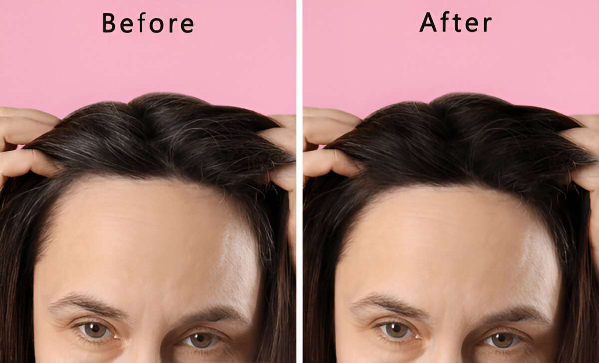 How Long Does It Take for a Hair Transplant to Grow