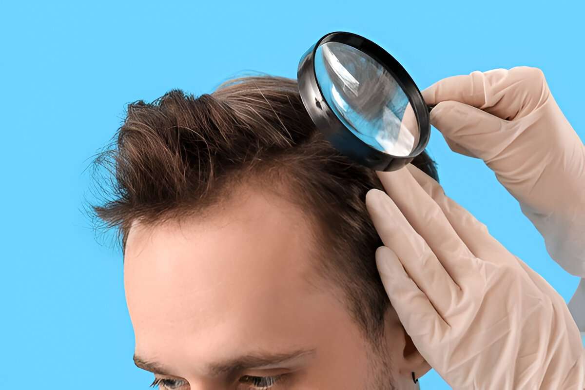 Hair Loss