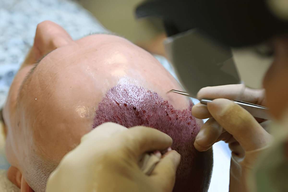 The Best Hair Transplant Clinics Outside of London