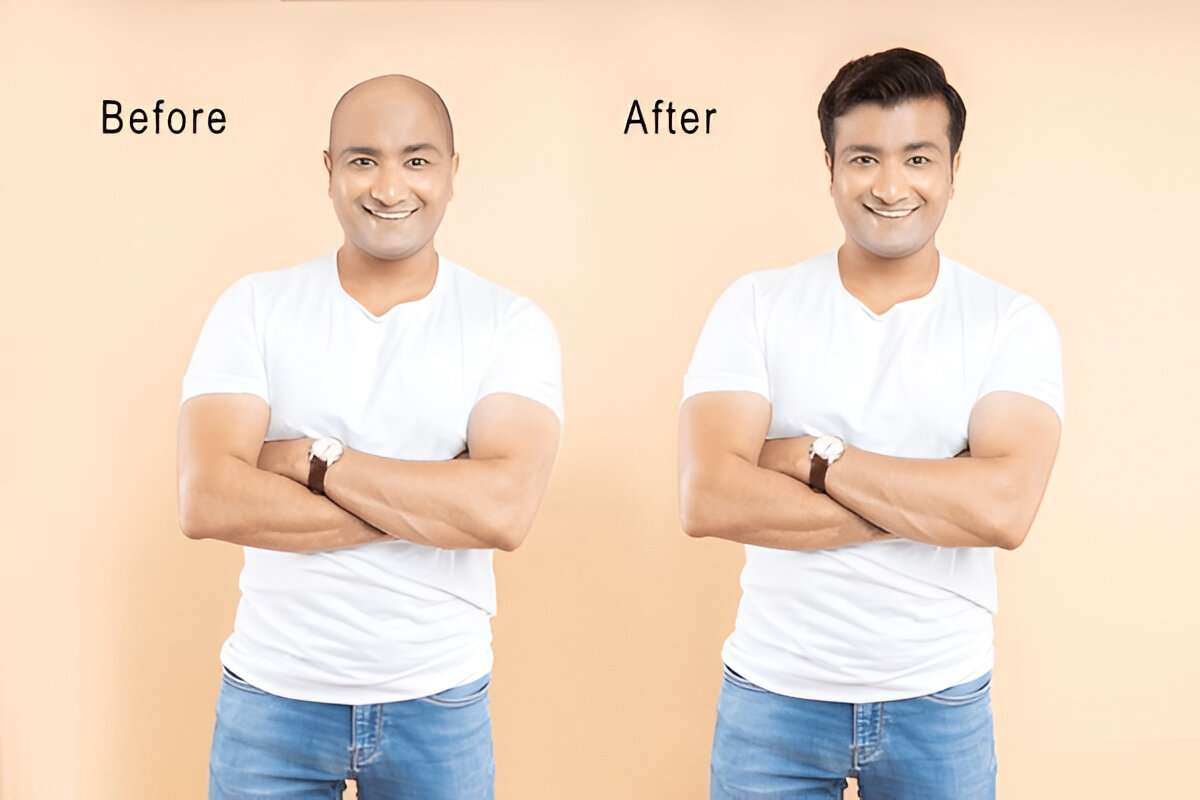 Do Hair Transplants Leave Scars?