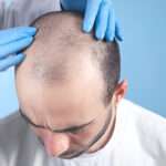 How to Choose a Reliable Hair Transplant Clinic in the UK