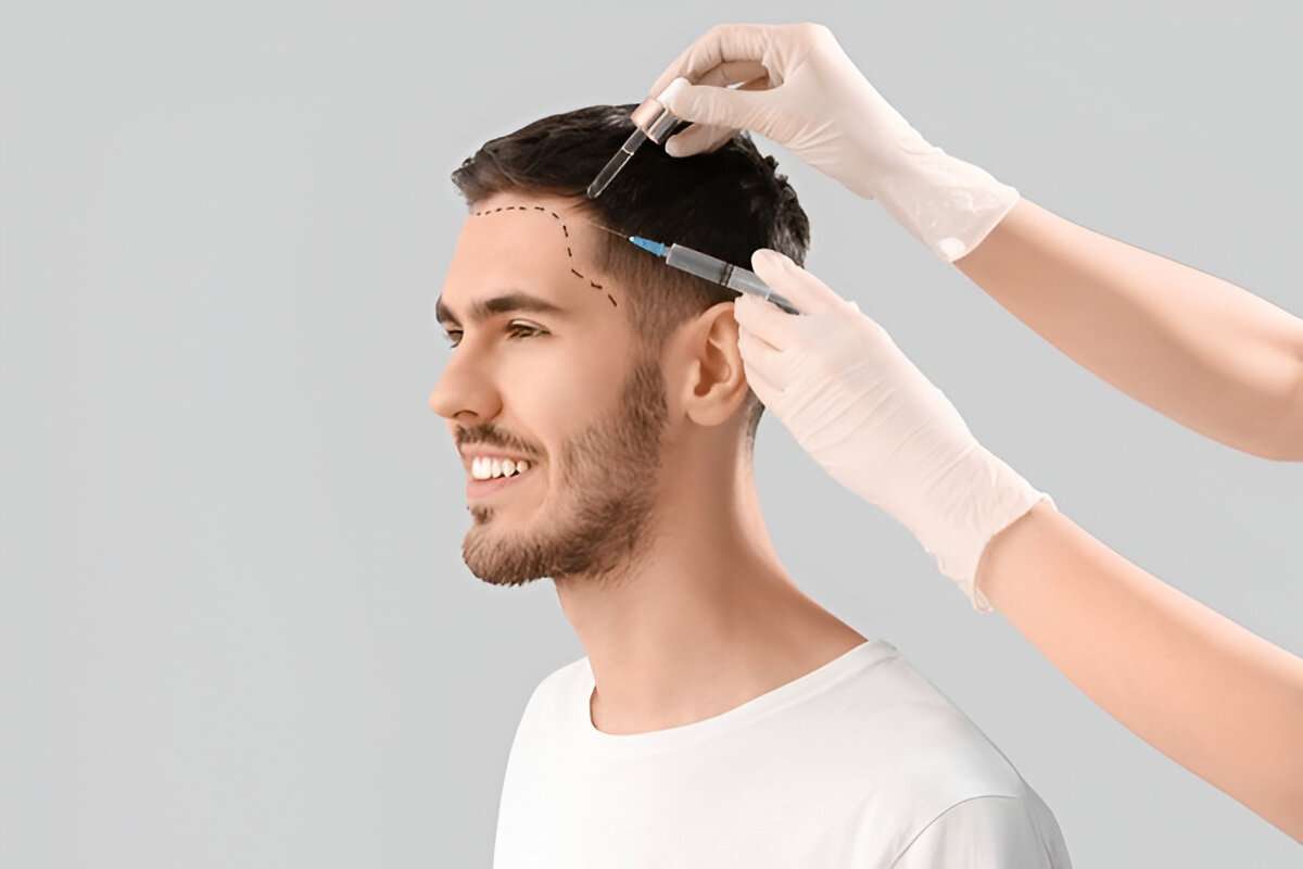 hair transplant Bristol