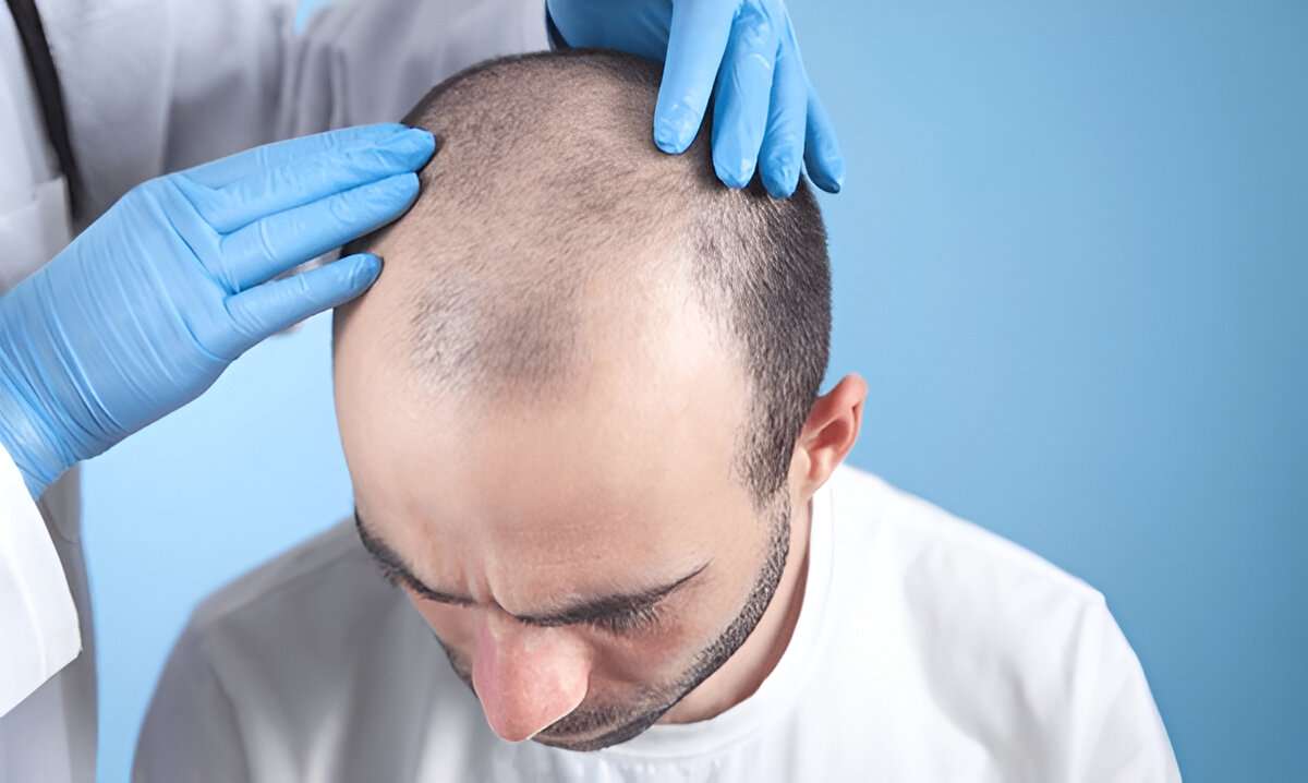 Hair Transplant