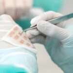 What Happens If Your Hair Transplant Doesn’t Grow?