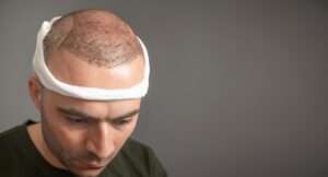 The Complete Timeline of a Hair Transplant Recovery