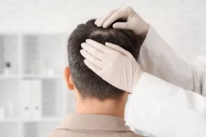 Does Age Affect the Success of Your Hair Transplant?