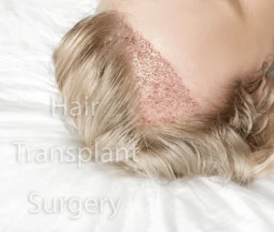 What Is the Role of Genetics in Hair Transplants?