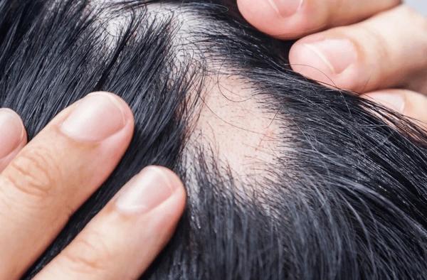 Best Approaches to Hair Transplant Treatment for Men