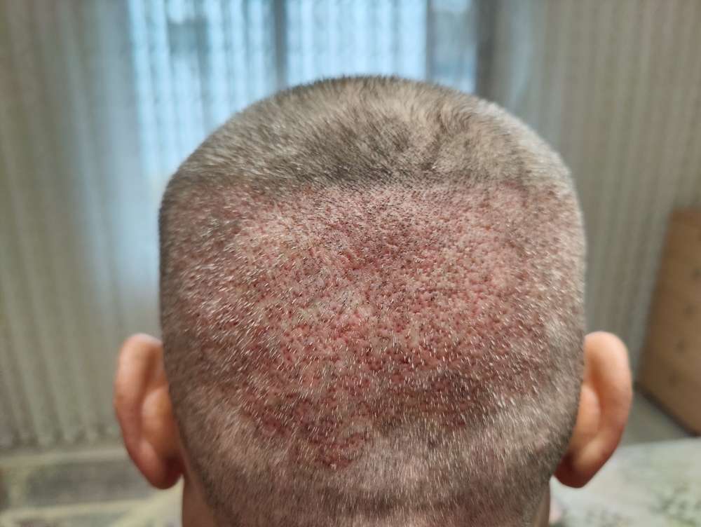 Can Minoxidil Actually Save a Receding Hairline?