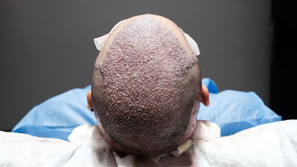 The Realistic Timeline for Regrowing Your Hair