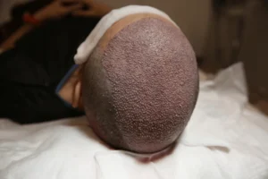 Real Ketoconazole Shampoo Results