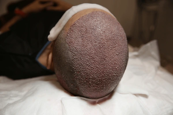 Real Ketoconazole Shampoo Results